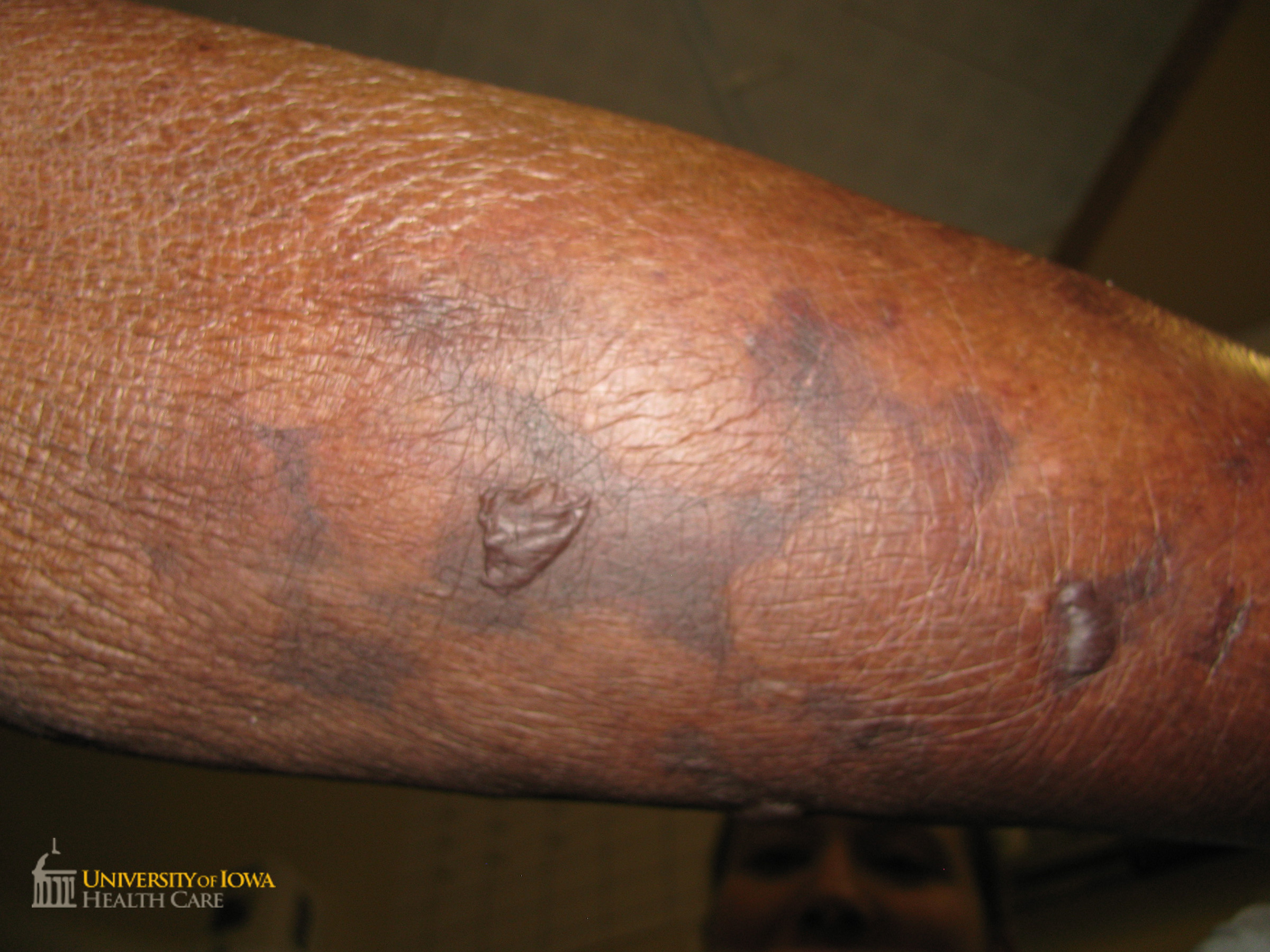 Retiform purpura on the leg and bulla on the leg. (click images for higher resolution).